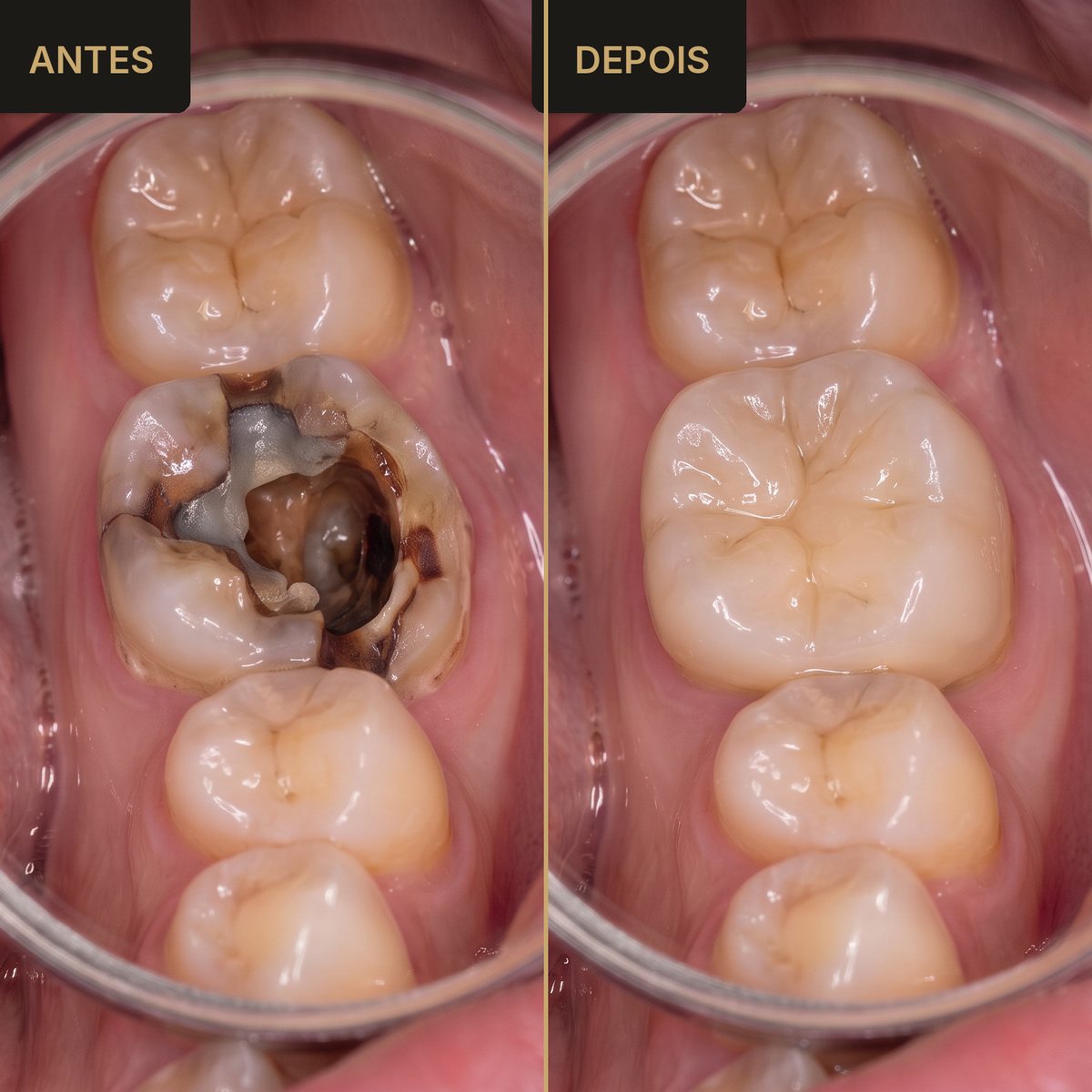 Antes e depois - coroa em porcelana em dente quebrado - Dra. Carol Cotes, São José dos Campos