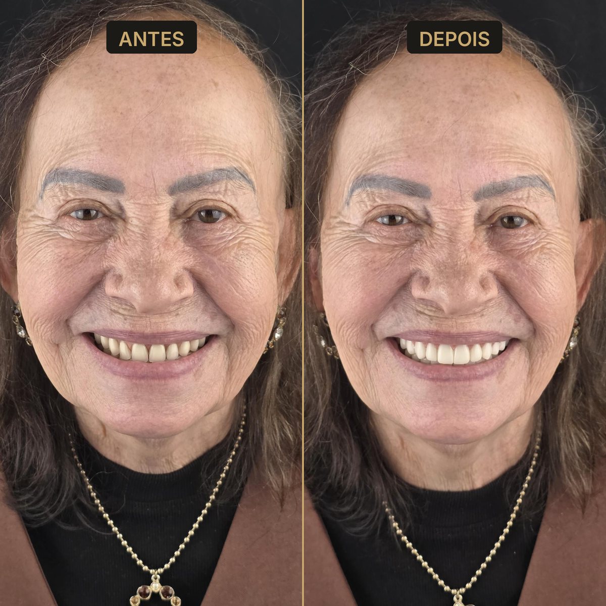 Antes e depois - troca de dentaduras - Dra. Carol Cotes, São José dos Campos