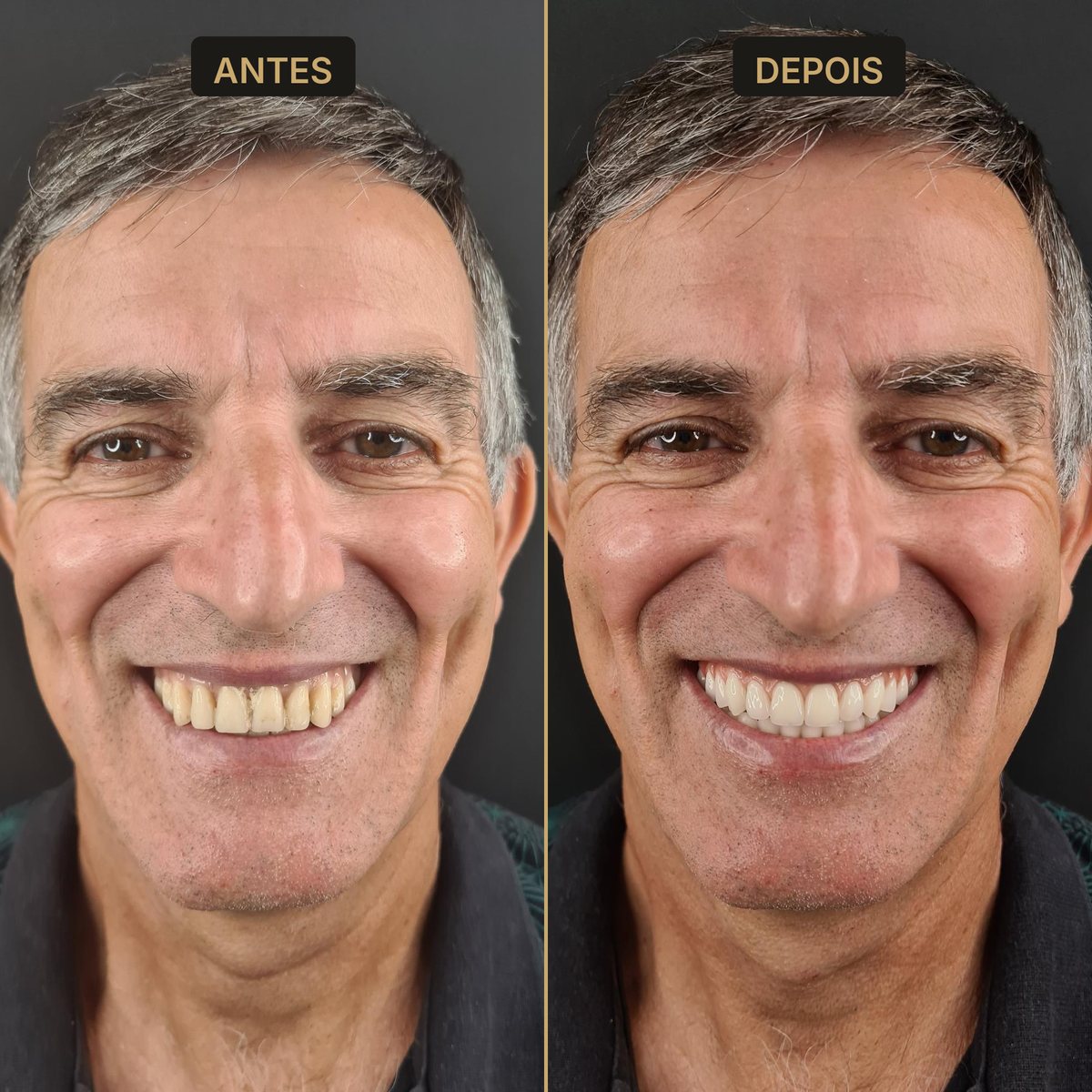 Antes e depois - reabilitação oral - Dra. Carol Cotes