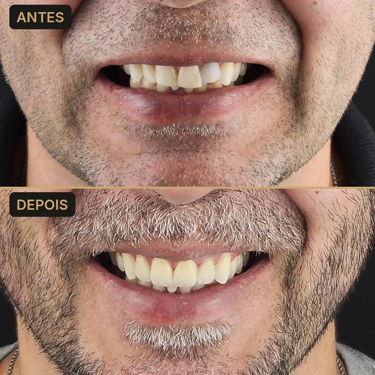 Antes e depois - 4 coroas em porcelana - Dra. Carol Cotes, São José dos Campos