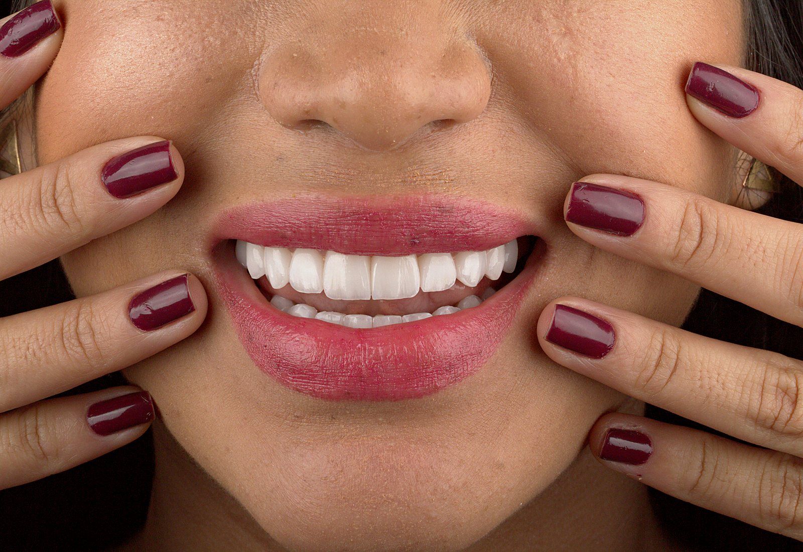 Sorriso com lente de contato dental em porcelana - caso da Dra. Carol Cotes, São José dos Campos